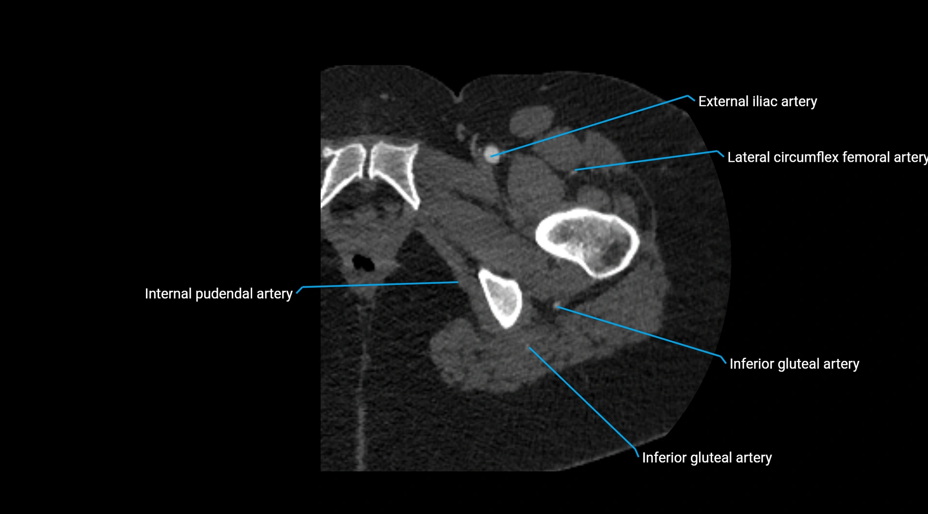 CTA lower limb cross sectional anatomy labelled image _65.webp
